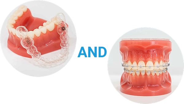 AND：ワイヤー矯正とマウスピース型矯正の併用