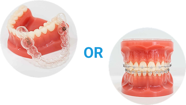 OR：ワイヤー矯正とマウスピース型矯正いずれかの使用