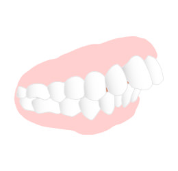 歯ならび：出っ歯